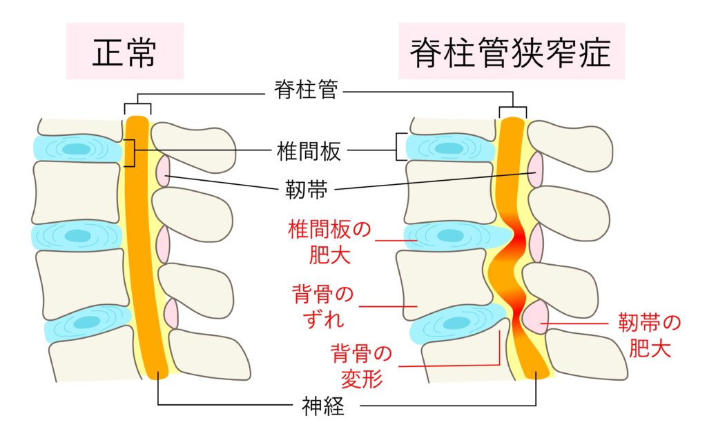 ガードナーベルト 脊柱管狭窄症